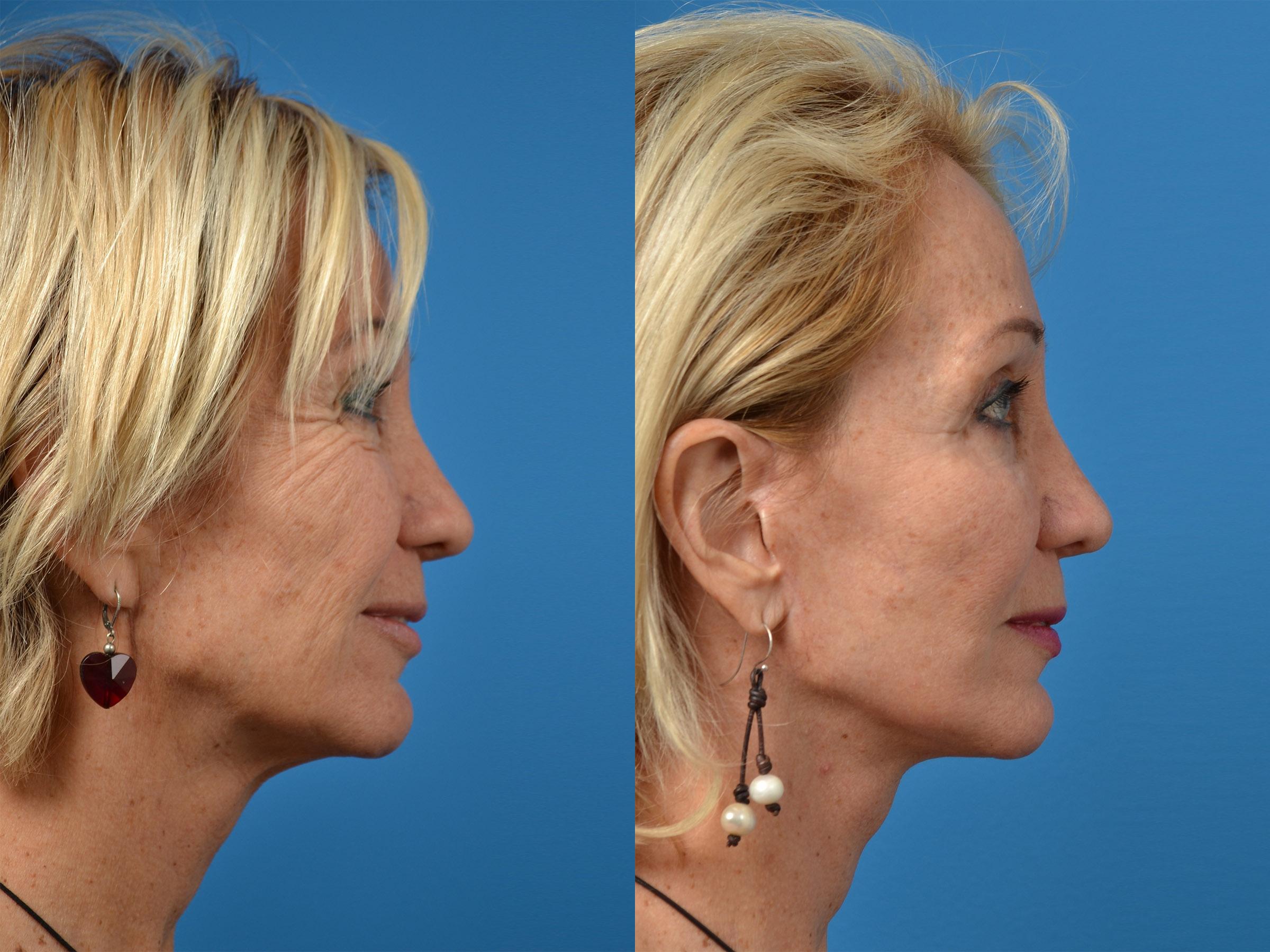 Laser Assisted Weekend Neck Lift Photos Melbourne Fl Patient 52568